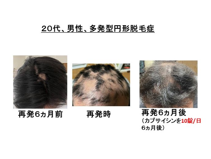 円形脱毛症　病院